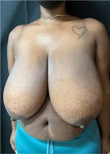 Breast Reduction Before Photo by M. Zakir Sabry, MD; New York, NY - Case 51336