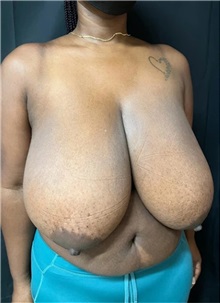 Breast Reduction Before Photo by M. Zakir Sabry, MD; New York, NY - Case 51336
