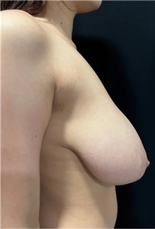 Tummy Tuck Before Photo by M. Zakir Sabry, MD; New York, NY - Case 51339