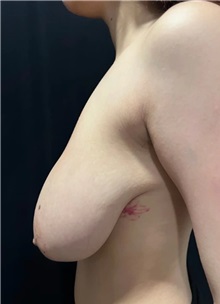 Tummy Tuck Before Photo by M. Zakir Sabry, MD; New York, NY - Case 51339