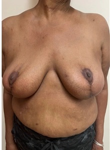 Breast Reduction After Photo by M. Zakir Sabry, MD; New York, NY - Case 51341