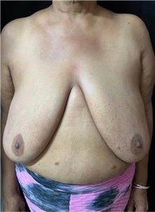 Breast Reduction Before Photo by M. Zakir Sabry, MD; New York, NY - Case 51341