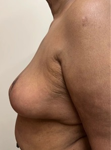Breast Reduction After Photo by M. Zakir Sabry, MD; New York, NY - Case 51341