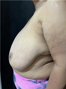 Breast Reduction Before Photo by M. Zakir Sabry, MD; New York, NY - Case 51341