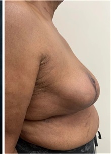 Breast Reduction After Photo by M. Zakir Sabry, MD; New York, NY - Case 51341