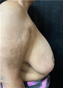 Breast Reduction Before Photo by M. Zakir Sabry, MD; New York, NY - Case 51341