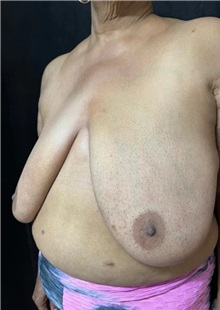 Breast Reduction Before Photo by M. Zakir Sabry, MD; New York, NY - Case 51341