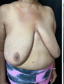 Breast Reduction Before Photo by M. Zakir Sabry, MD; New York, NY - Case 51341