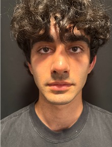 Rhinoplasty After Photo by M. Zakir Sabry, MD; New York, NY - Case 51399