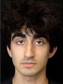 Rhinoplasty Before Photo by M. Zakir Sabry, MD; New York, NY - Case 51399