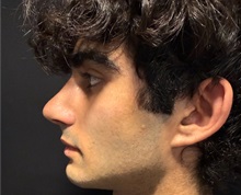 Rhinoplasty After Photo by M. Zakir Sabry, MD; New York, NY - Case 51399