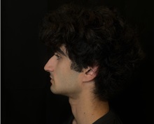 Rhinoplasty Before Photo by M. Zakir Sabry, MD; New York, NY - Case 51399