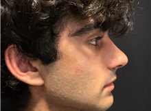 Rhinoplasty After Photo by M. Zakir Sabry, MD; New York, NY - Case 51399