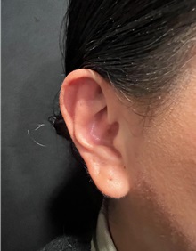 Ear Surgery After Photo by M. Zakir Sabry, MD; New York, NY - Case 51402