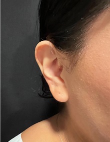 Ear Surgery Before Photo by M. Zakir Sabry, MD; New York, NY - Case 51402