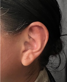 Ear Surgery After Photo by M. Zakir Sabry, MD; New York, NY - Case 51402