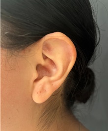 Ear Surgery Before Photo by M. Zakir Sabry, MD; New York, NY - Case 51402