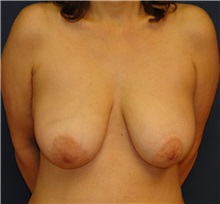 Breast Lift Before Photo by Matthew Kilgo, MD, FACS; Garden City, NY - Case 27987