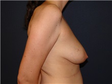 Breast Reconstruction Before Photo by Matthew Kilgo, MD, FACS; Garden City, NY - Case 28529
