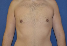 Male Breast Reduction After Photo by Matthew Kilgo, MD, FACS; Garden City, NY - Case 28539
