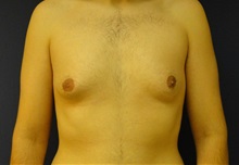 Male Breast Reduction Before Photo by Matthew Kilgo, MD, FACS; Garden City, NY - Case 28539
