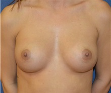Breast Augmentation After Photo by Matthew Kilgo, MD, FACS; Garden City, NY - Case 29129