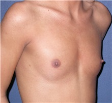 Breast Augmentation Before Photo by Matthew Kilgo, MD, FACS; Garden City, NY - Case 29129