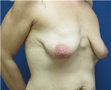 Breast Reconstruction Before Photo by Matthew Kilgo, MD, FACS; Garden City, NY - Case 29132