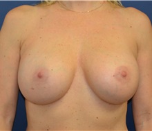 Breast Augmentation After Photo by Matthew Kilgo, MD, FACS; Garden City, NY - Case 30337