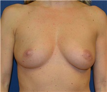 Breast Augmentation Before Photo by Matthew Kilgo, MD, FACS; Garden City, NY - Case 30337
