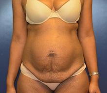 Tummy Tuck Before Photo by Matthew Kilgo, MD, FACS; Garden City, NY - Case 30361