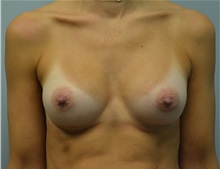 Breast Augmentation After Photo by Matthew Kilgo, MD, FACS; Garden City, NY - Case 33208