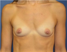 Breast Augmentation Before Photo by Matthew Kilgo, MD, FACS; Garden City, NY - Case 33208