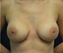 Breast Augmentation After Photo by Matthew Kilgo, MD, FACS; Garden City, NY - Case 33209