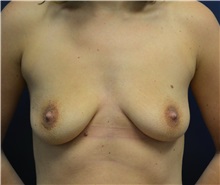 Breast Augmentation Before Photo by Matthew Kilgo, MD, FACS; Garden City, NY - Case 33209