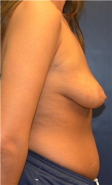 Breast Lift Before Photo by Matthew Kilgo, MD, FACS; Garden City, NY - Case 33212