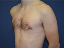 Male Breast Reduction After Photo by Matthew Kilgo, MD, FACS; Garden City, NY - Case 33214