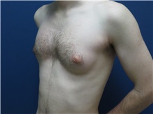 Male Breast Reduction Before Photo by Matthew Kilgo, MD, FACS; Garden City, NY - Case 33214