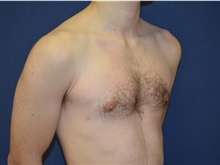 Male Breast Reduction After Photo by Matthew Kilgo, MD, FACS; Garden City, NY - Case 33214