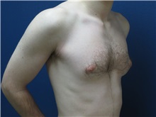 Male Breast Reduction Before Photo by Matthew Kilgo, MD, FACS; Garden City, NY - Case 33214