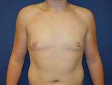 Male Breast Reduction After Photo by Matthew Kilgo, MD, FACS; Garden City, NY - Case 33217