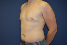 Male Breast Reduction After Photo by Matthew Kilgo, MD, FACS; Garden City, NY - Case 33217