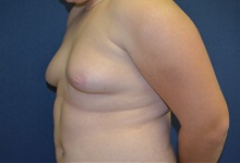 Male Breast Reduction Before Photo by Matthew Kilgo, MD, FACS; Garden City, NY - Case 33217