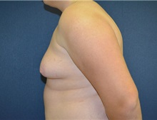 Male Breast Reduction Before Photo by Matthew Kilgo, MD, FACS; Garden City, NY - Case 33217