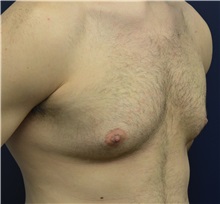 Male Breast Reduction Before Photo by Matthew Kilgo, MD, FACS; Garden City, NY - Case 33219