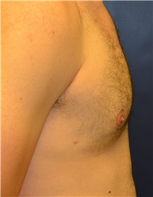 Male Breast Reduction After Photo by Matthew Kilgo, MD, FACS; Garden City, NY - Case 33219