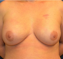 Breast Reconstruction After Photo by Matthew Kilgo, MD, FACS; Garden City, NY - Case 33223