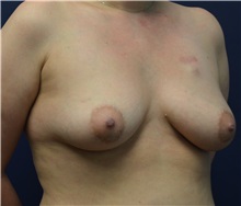 Breast Reconstruction Before Photo by Matthew Kilgo, MD, FACS; Garden City, NY - Case 33223