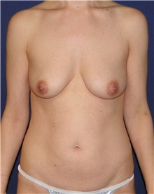 Breast Augmentation Before Photo by Matthew Kilgo, MD, FACS; Garden City, NY - Case 33438