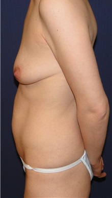 Breast Augmentation Before Photo by Matthew Kilgo, MD, FACS; Garden City, NY - Case 33438